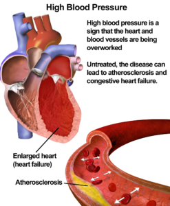 Risks of high blood pressure - ब्लड प्रेशर क्या होता है